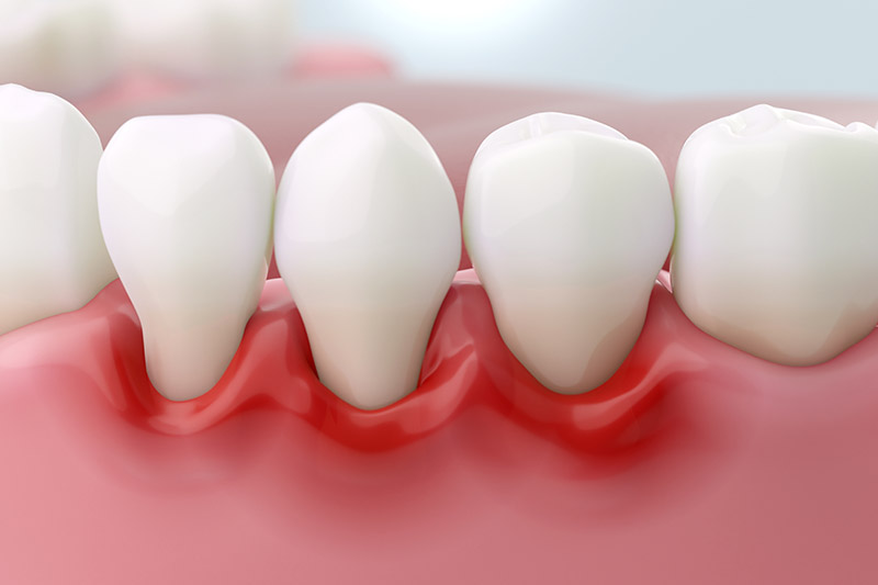 Gum Disease Treatment in Torrance
