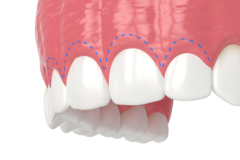 Gummy Smile in Torrance