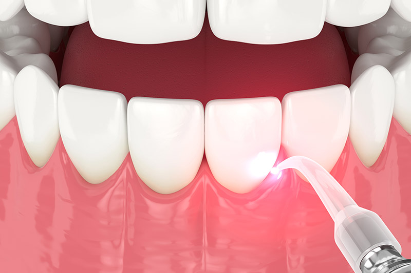 Laser (LANAP) Periodontal Surgery in Torrance