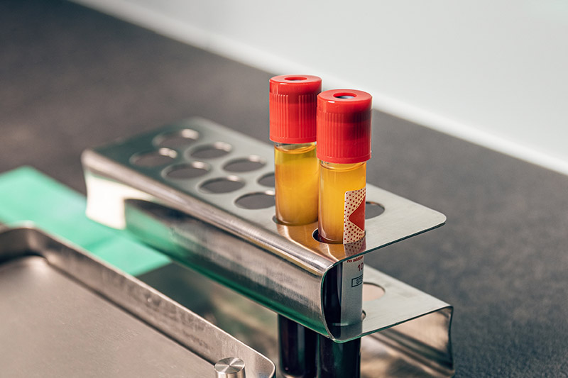 PRF Treatment in Dental in Torrance