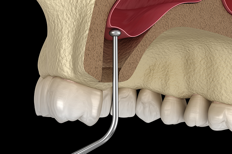 Sinus Lift in Torrance